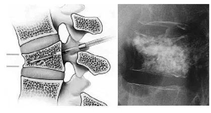 intervento colonna vertebrale affetta da osteoporosi