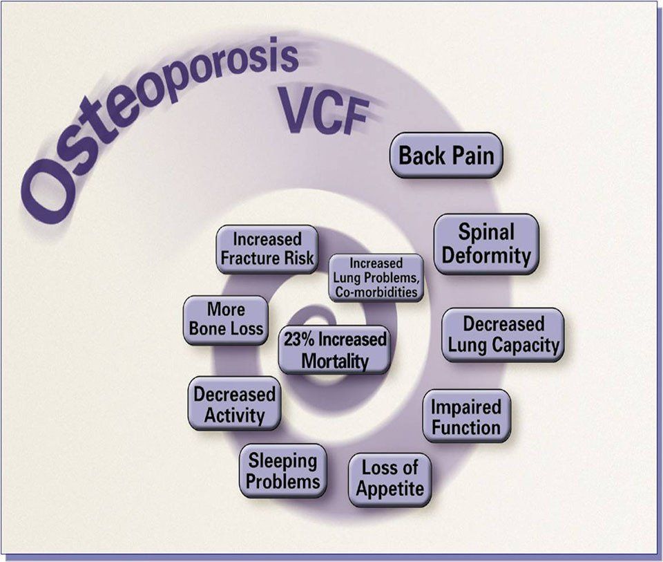 i sintomi dell'osteoporosi