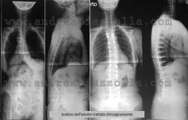 radiografia evidenzia scoliosi spinale
