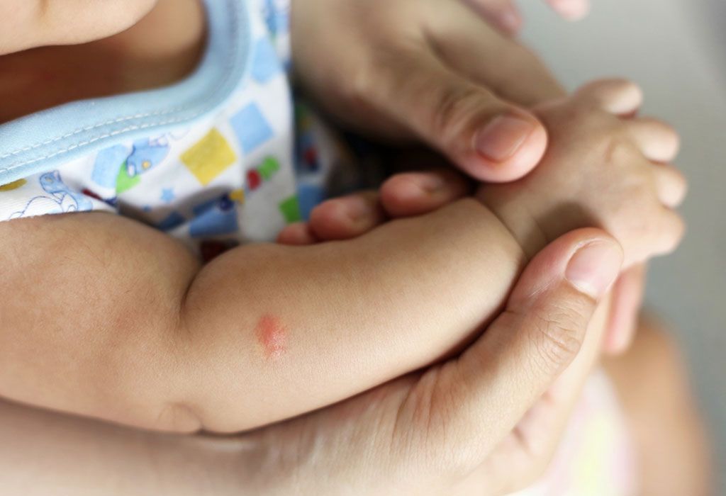 What to Put on Mosquito Bites for Babies?