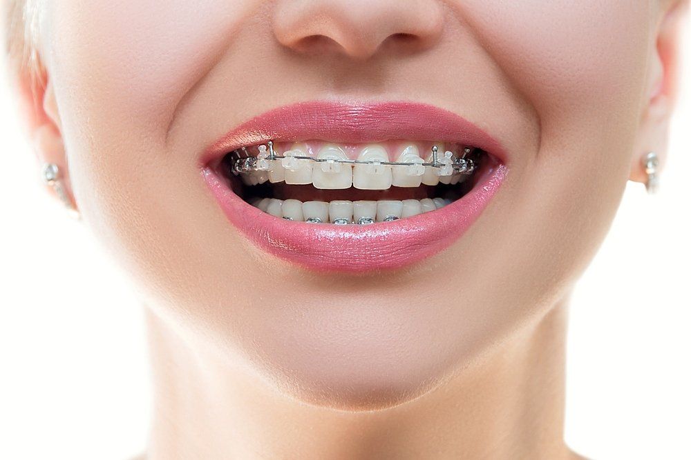 woman showing her braces