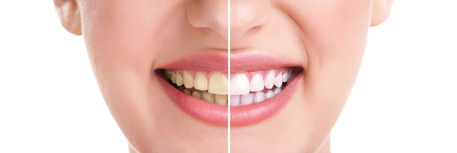 Side-by-side comparison shows stained teeth on the left transformed to white teeth on the right, smiling woman.