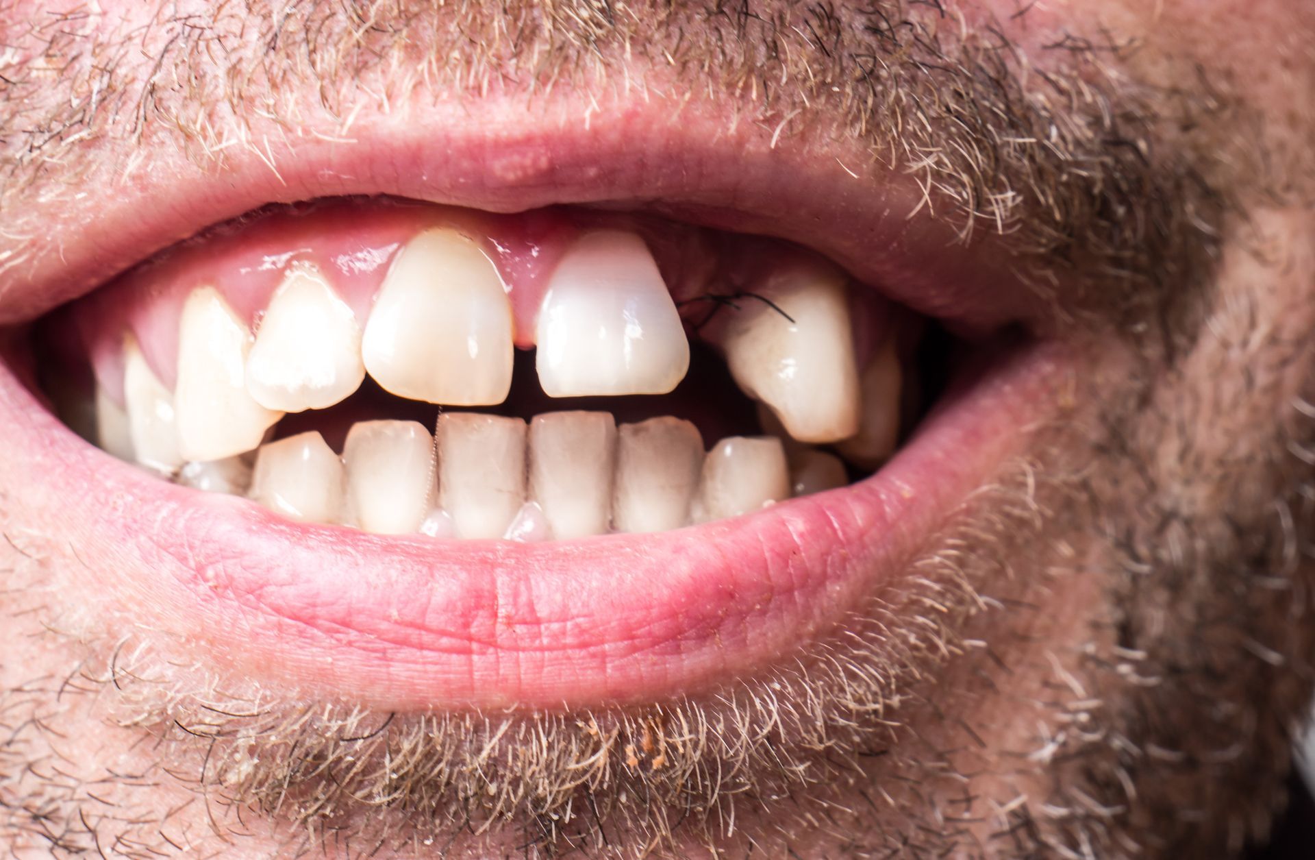 Close-up of a person's mouth with a missing front tooth and visible gaps between other teeth.