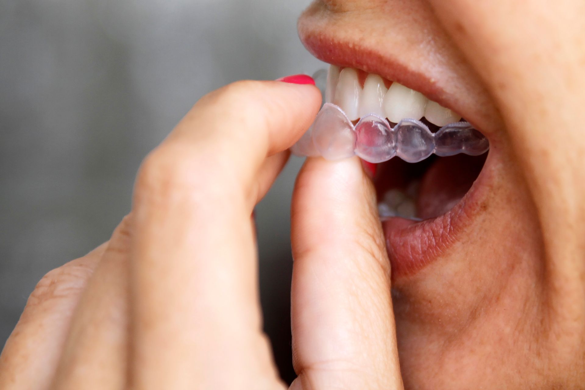 Person inserts clear aligner into mouth, teeth visible.