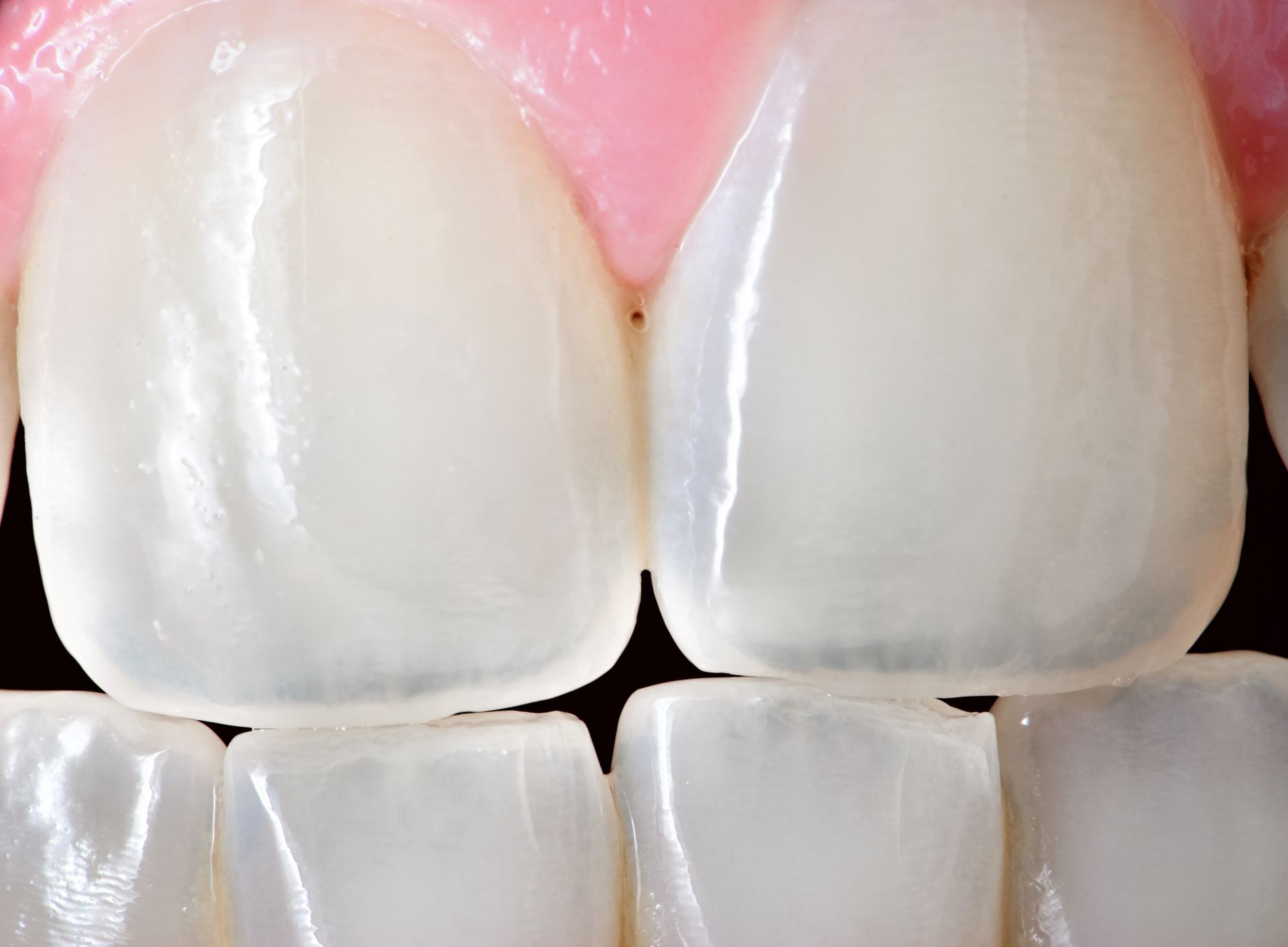 Close-up of two bright white teeth with a slightly translucent appearance, surrounded by pink gums.
