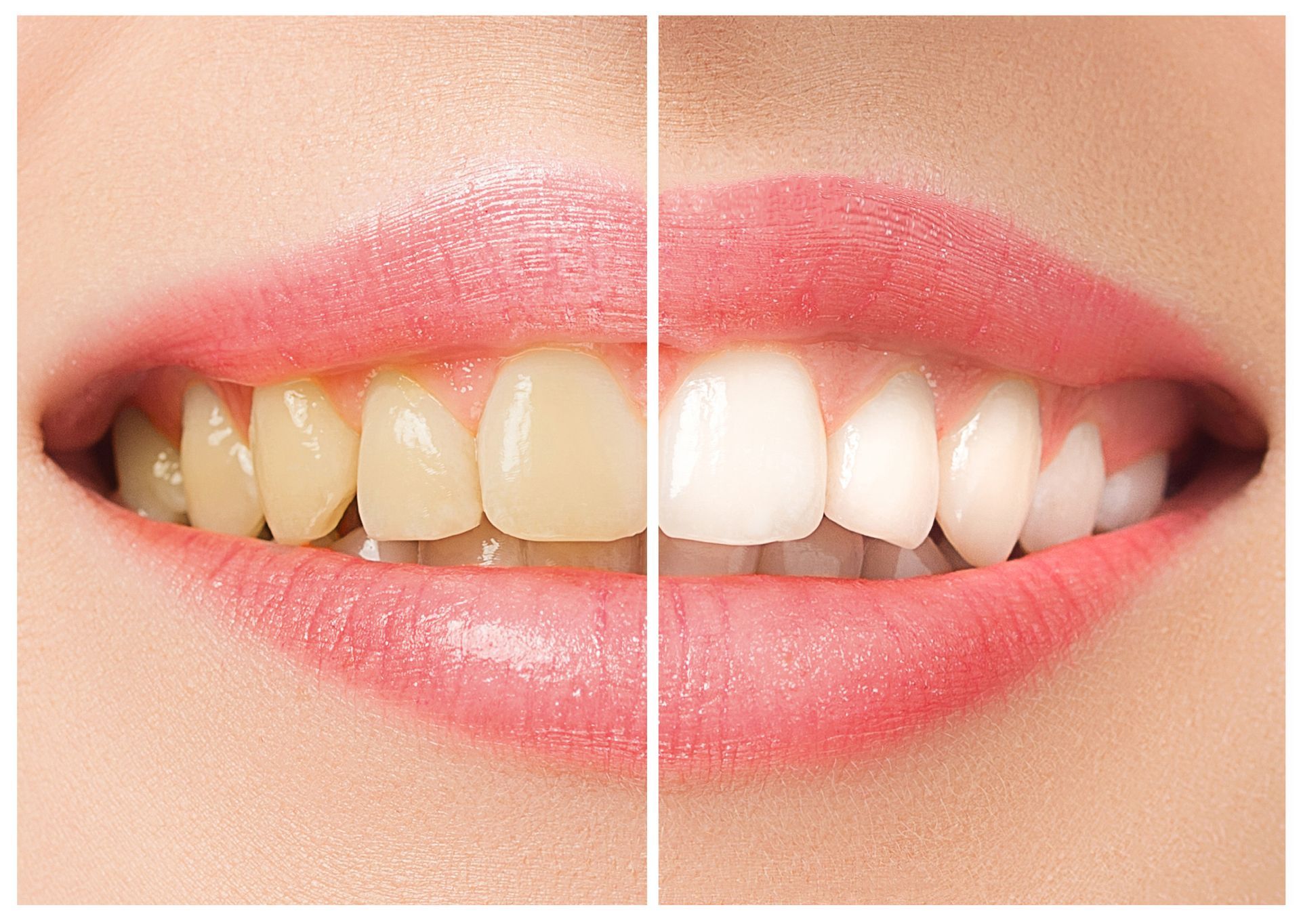 Side-by-side comparison: yellowed teeth on the left, bright white teeth on the right, both sets in a smiling mouth.