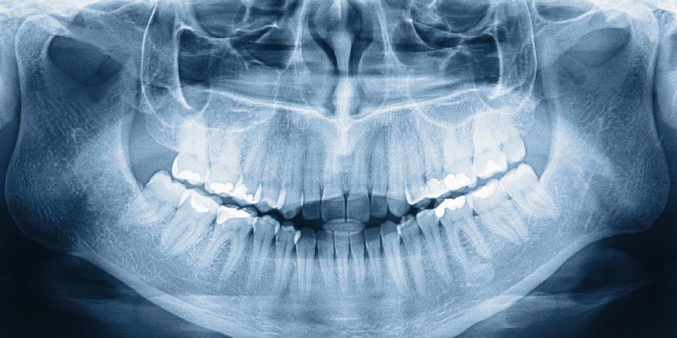 What You Should Know About Dental X-Rays