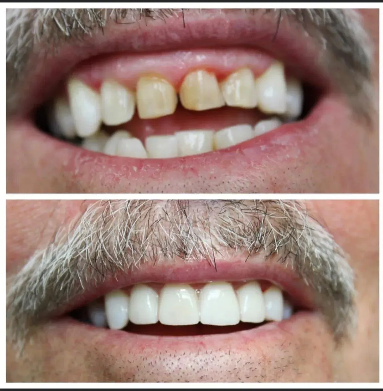 Before and after dental work: discolored teeth replaced with bright, white teeth.