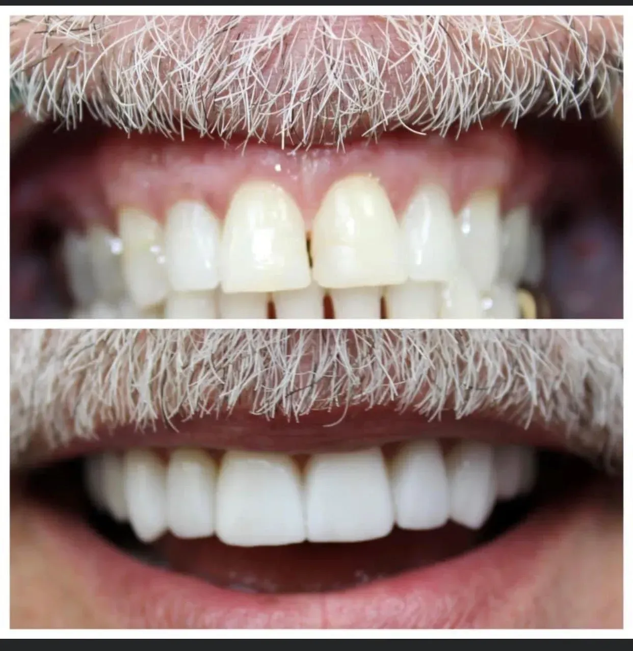 Before-and-after of teeth. Top row shows discolored teeth. Bottom row shows bright, white teeth.