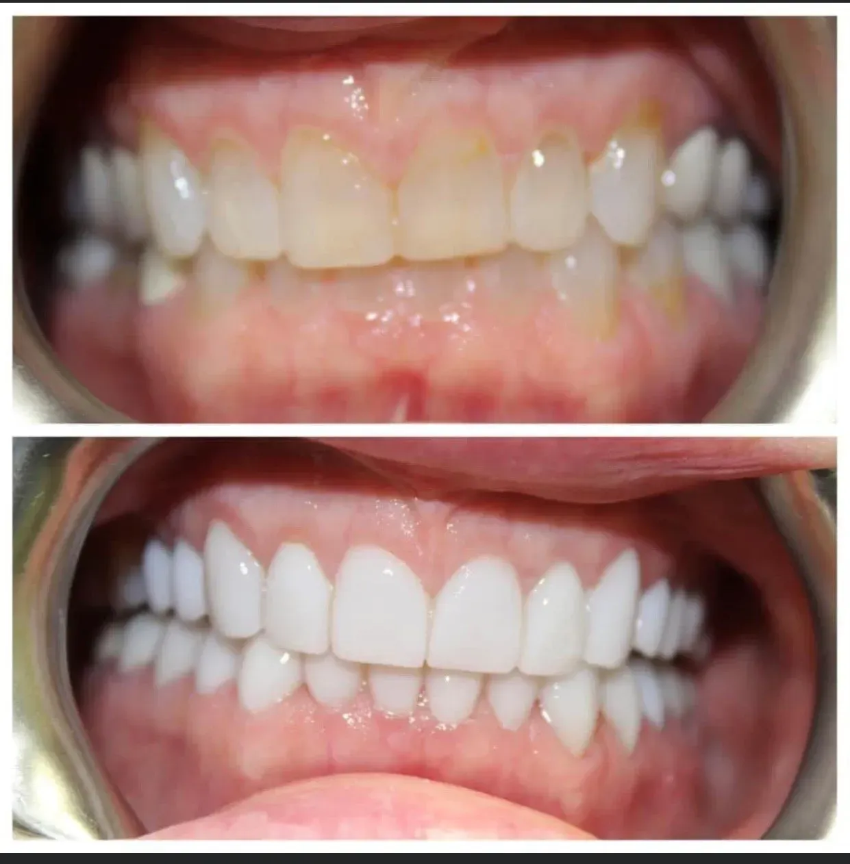 Before and after photos of teeth: yellowing to bright white with improved shape.