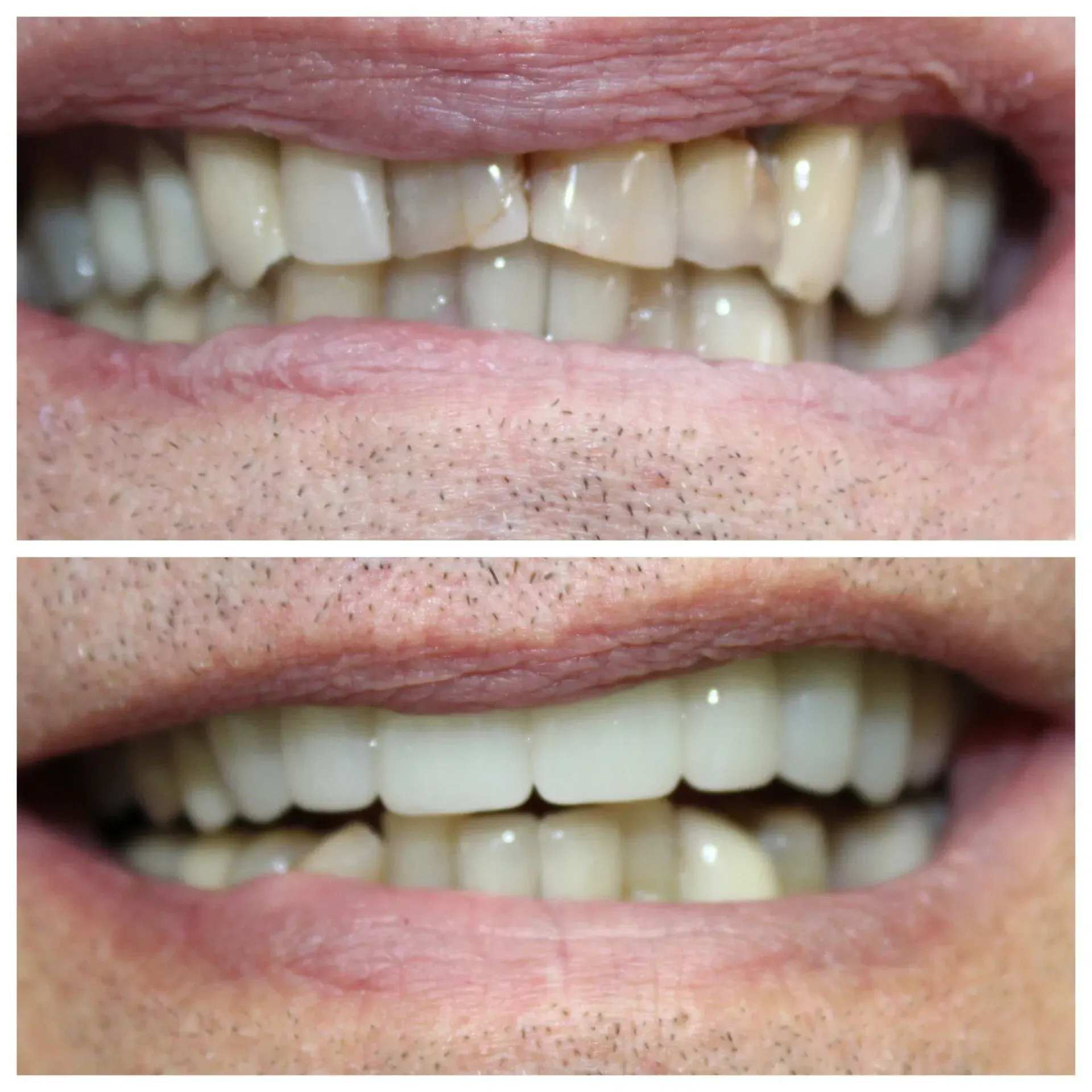 Before and after of teeth, showing improvement in color and alignment.