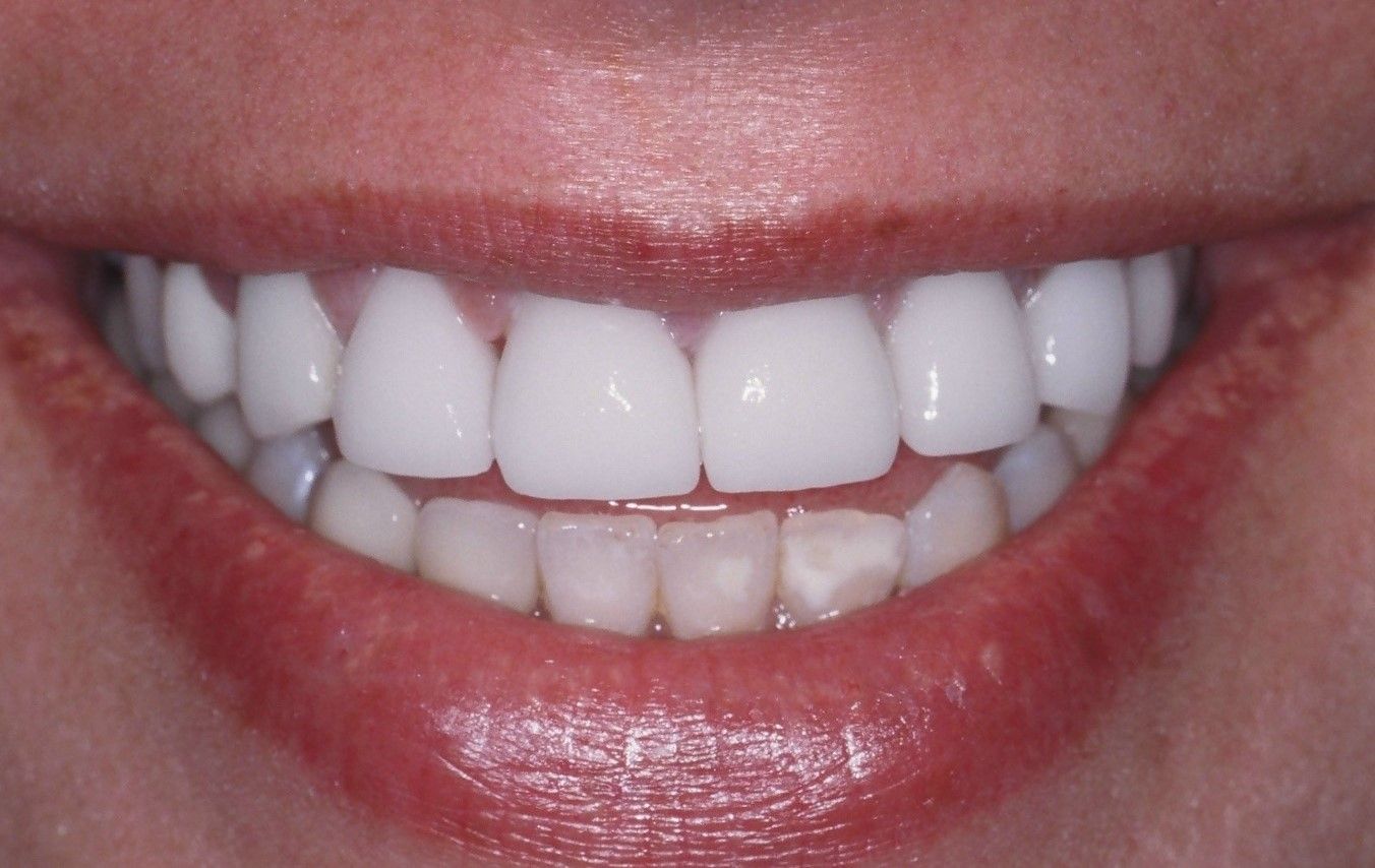 A close up of a woman 's smile with white teeth and red lips.