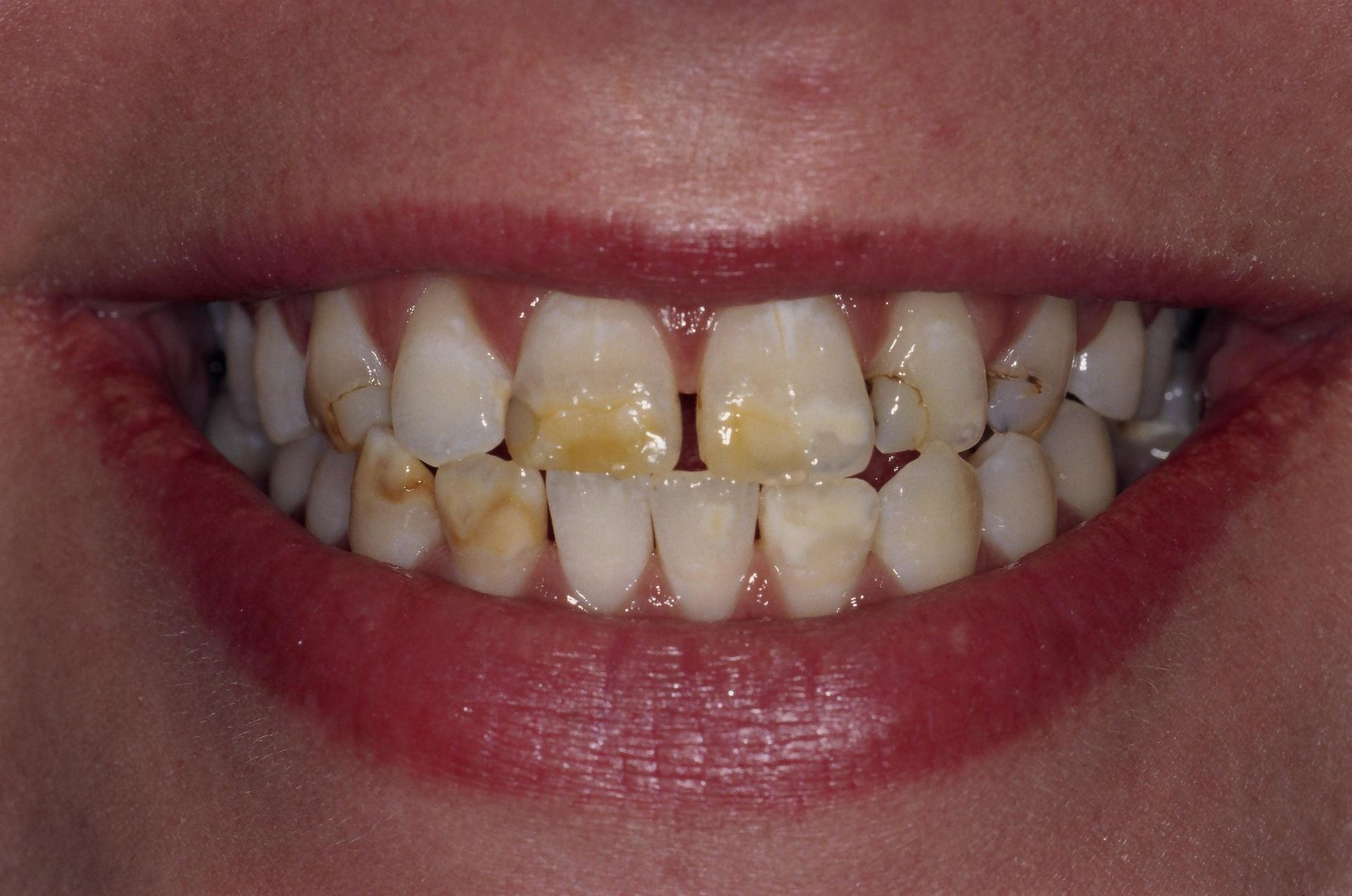 A close up of a person 's teeth with yellow spots on them.