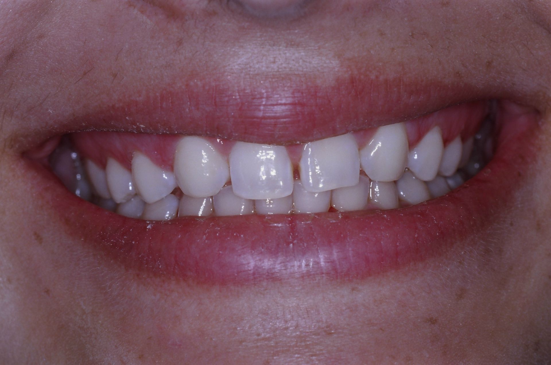 A close up of a person 's teeth with a broken tooth.