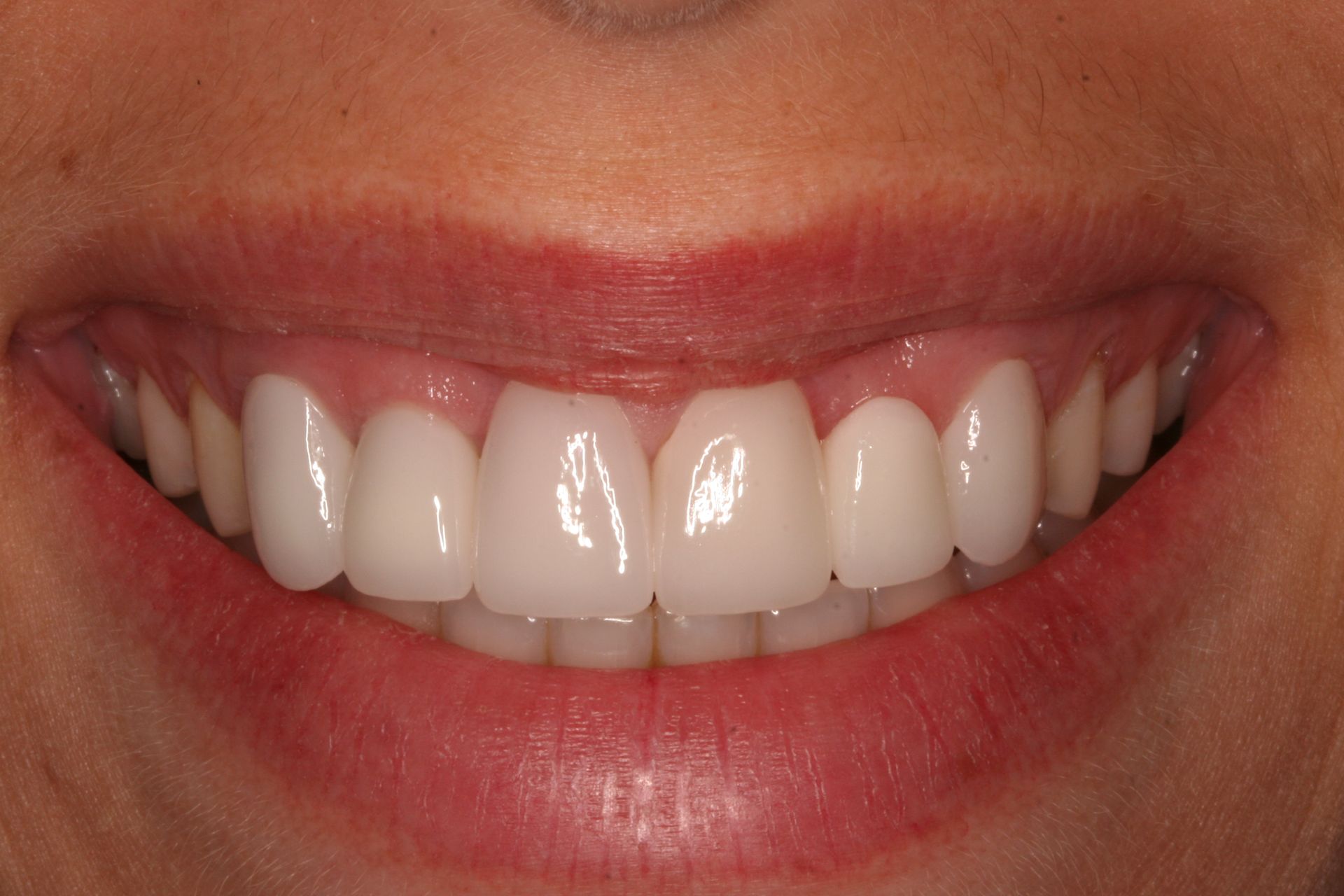A close up of a woman 's smile with white teeth.
