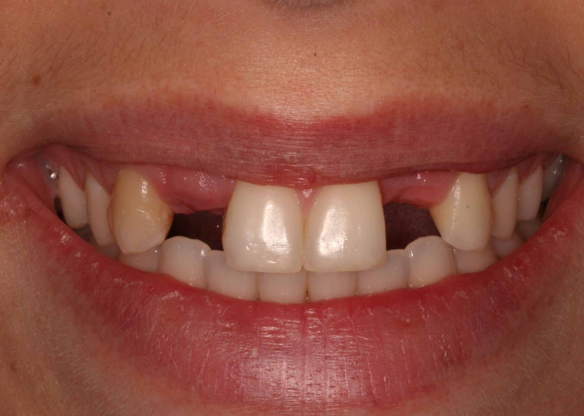A close up of a person 's mouth with missing teeth.