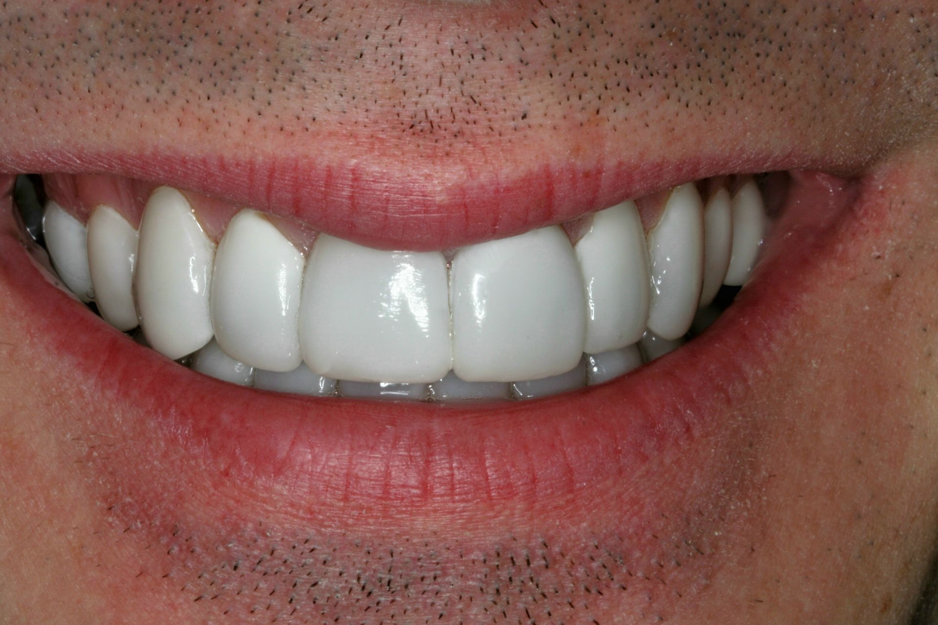A close up of a man 's smile with white teeth.