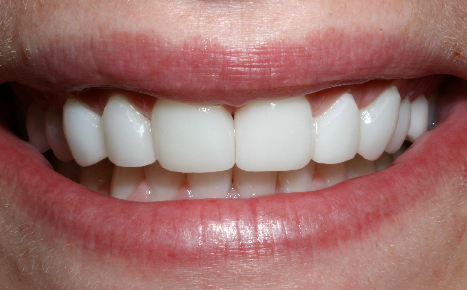 A close up of a woman 's smile with white teeth.
