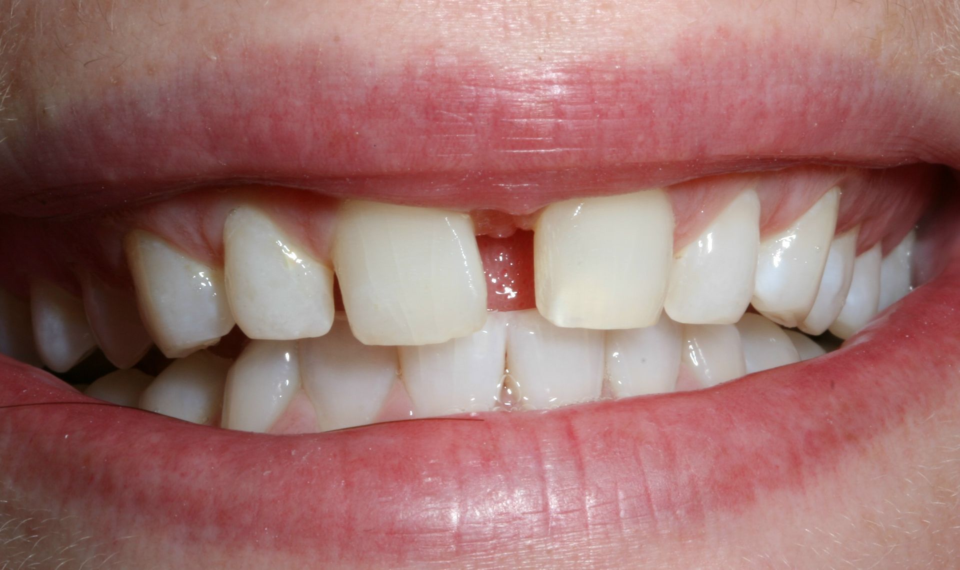 A close up of a person 's teeth with a missing tooth.