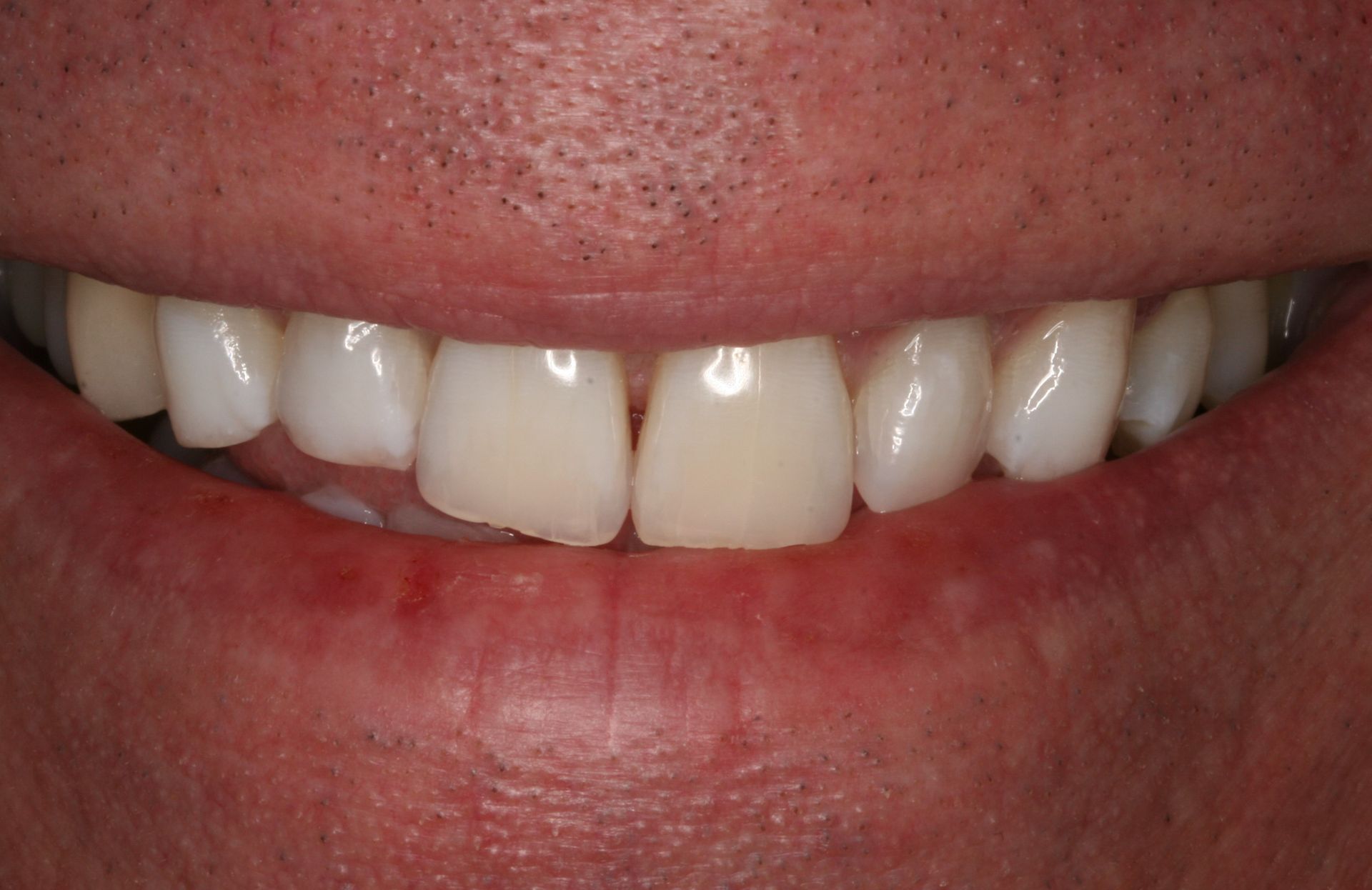 A close up of a man 's smile with white teeth.