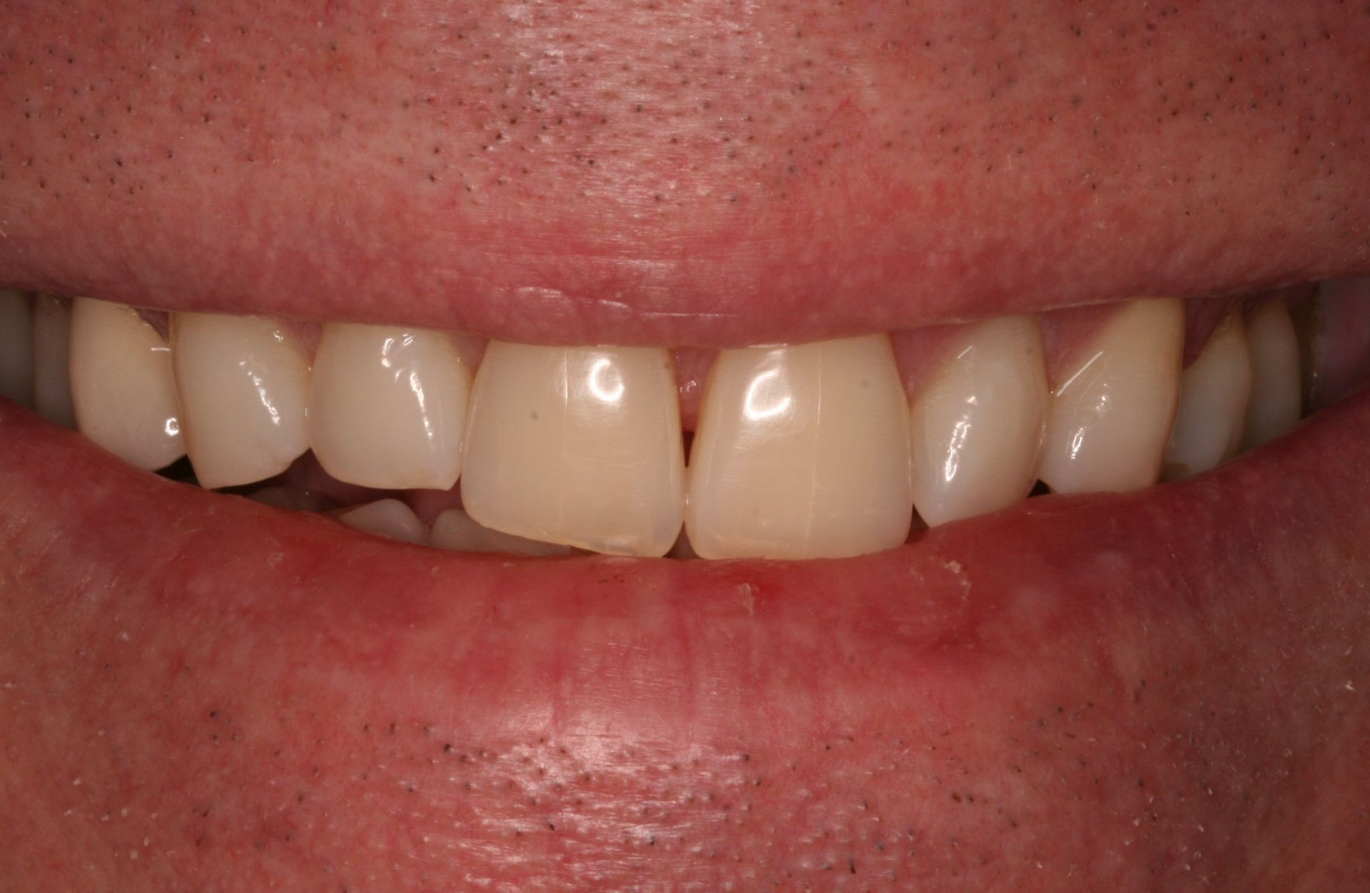 A close up of a man 's teeth with a missing tooth.
