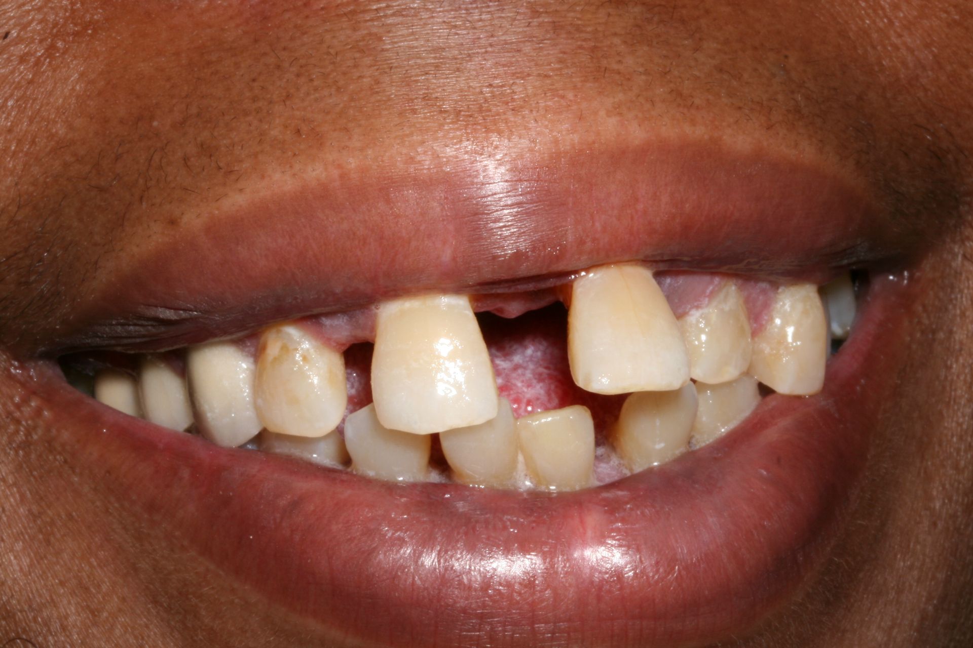 A close up of a person 's mouth with missing teeth.