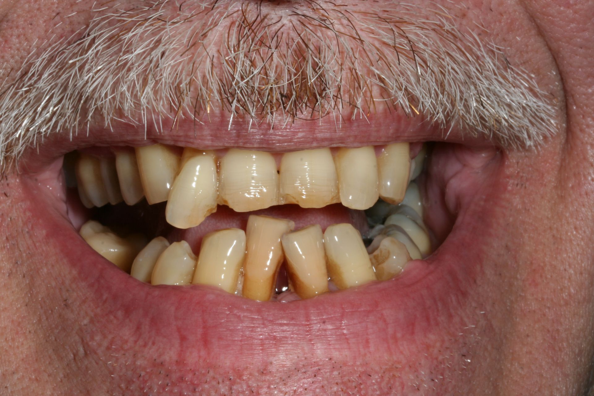 A close up of a man 's mouth with a beard and missing teeth.