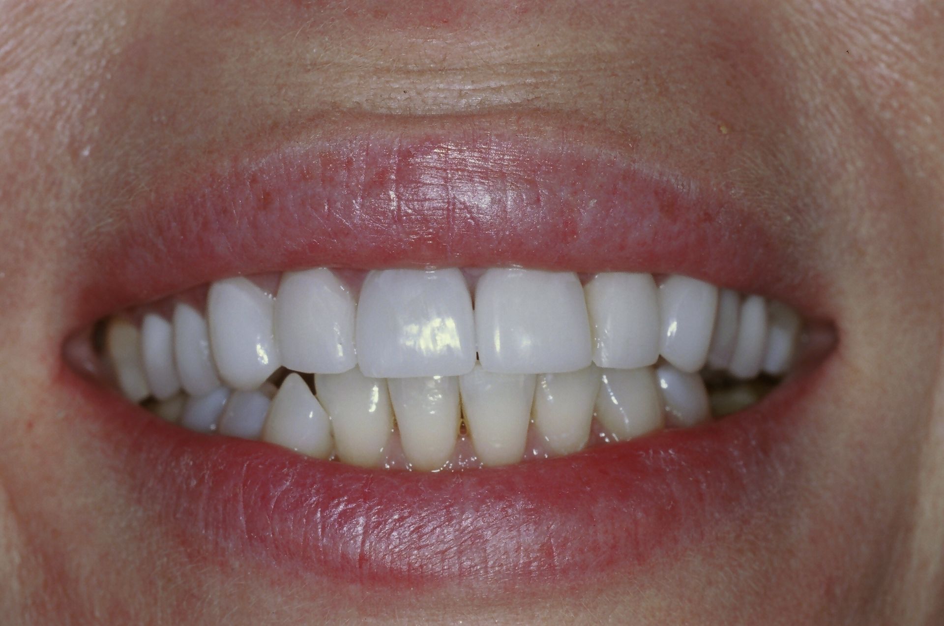 A close up of a woman 's mouth with white teeth