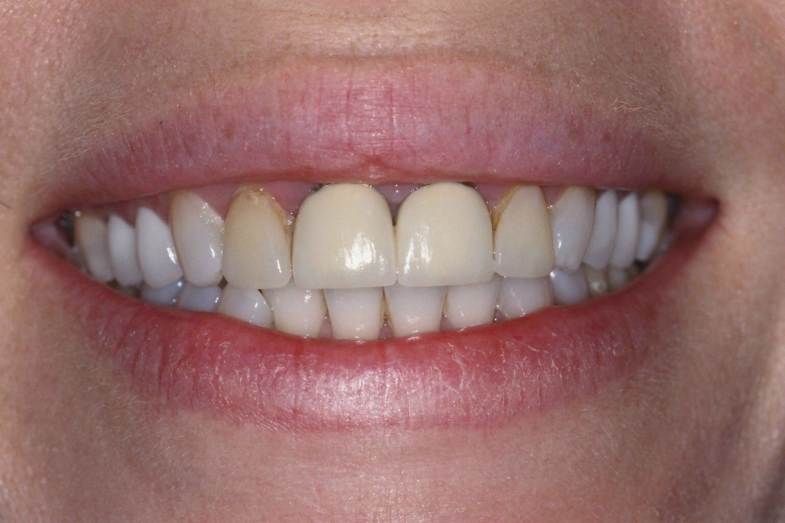 A close up of a woman 's smile with white teeth.