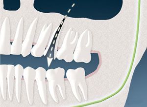 A close up of a person 's teeth with a green line going through them.