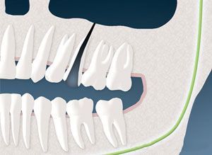 A close up of a person 's teeth with a green line between them.