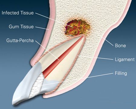 A diagram of a tooth with infected tissue and gum tissue