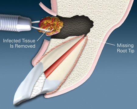 An illustration of a tooth with a missing root tip