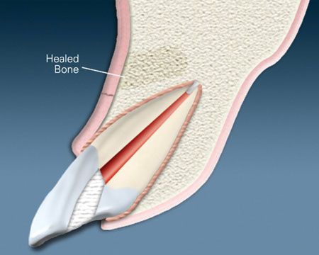 An illustration of a tooth with a healed bone