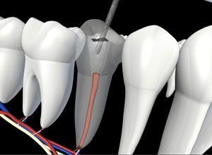 A computer generated image of a tooth getting a root canal treatment.