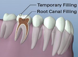 A diagram of a tooth with temporary filling and root canal filling