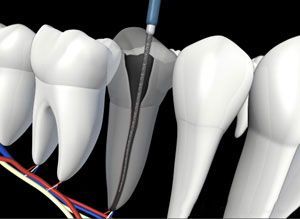 A computer generated image of a dental procedure being performed on a tooth.