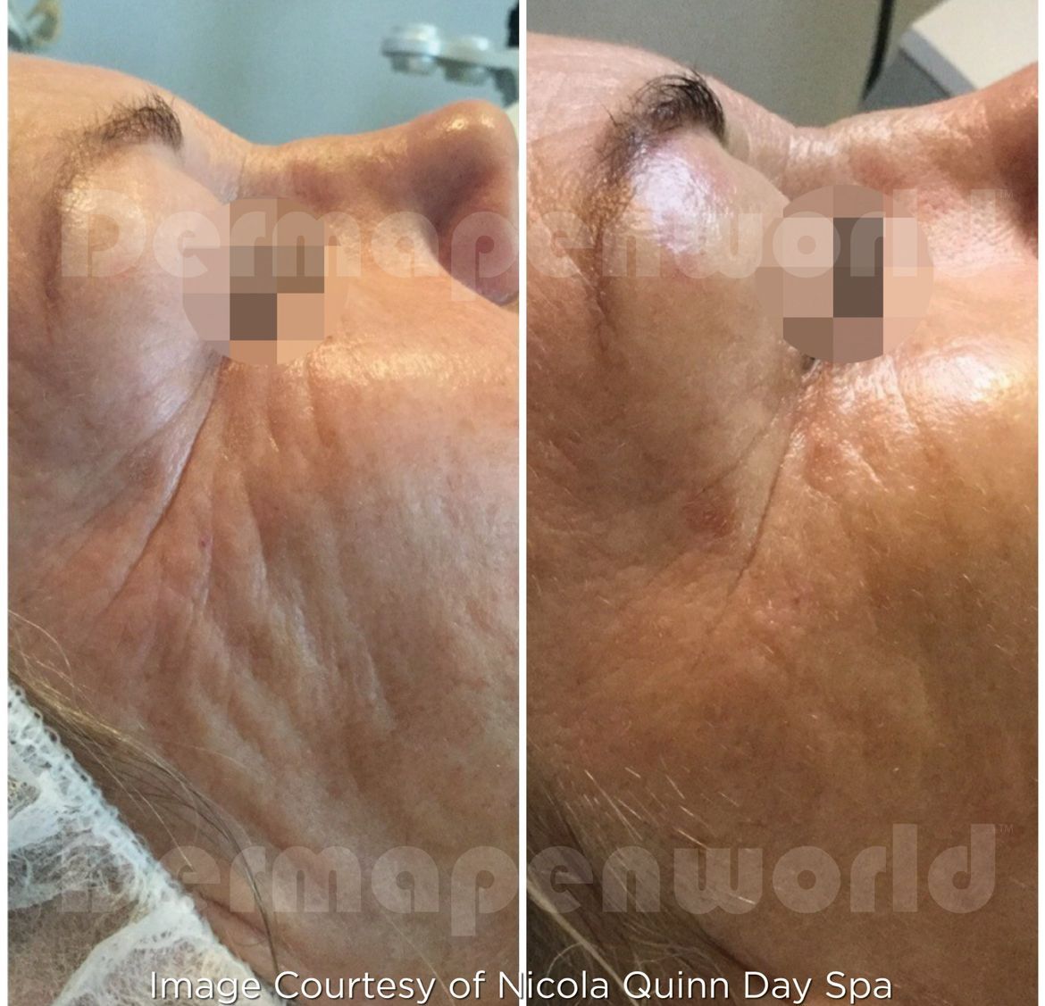 Ein Vorher-Nachher-Foto vom Gesicht einer Frau