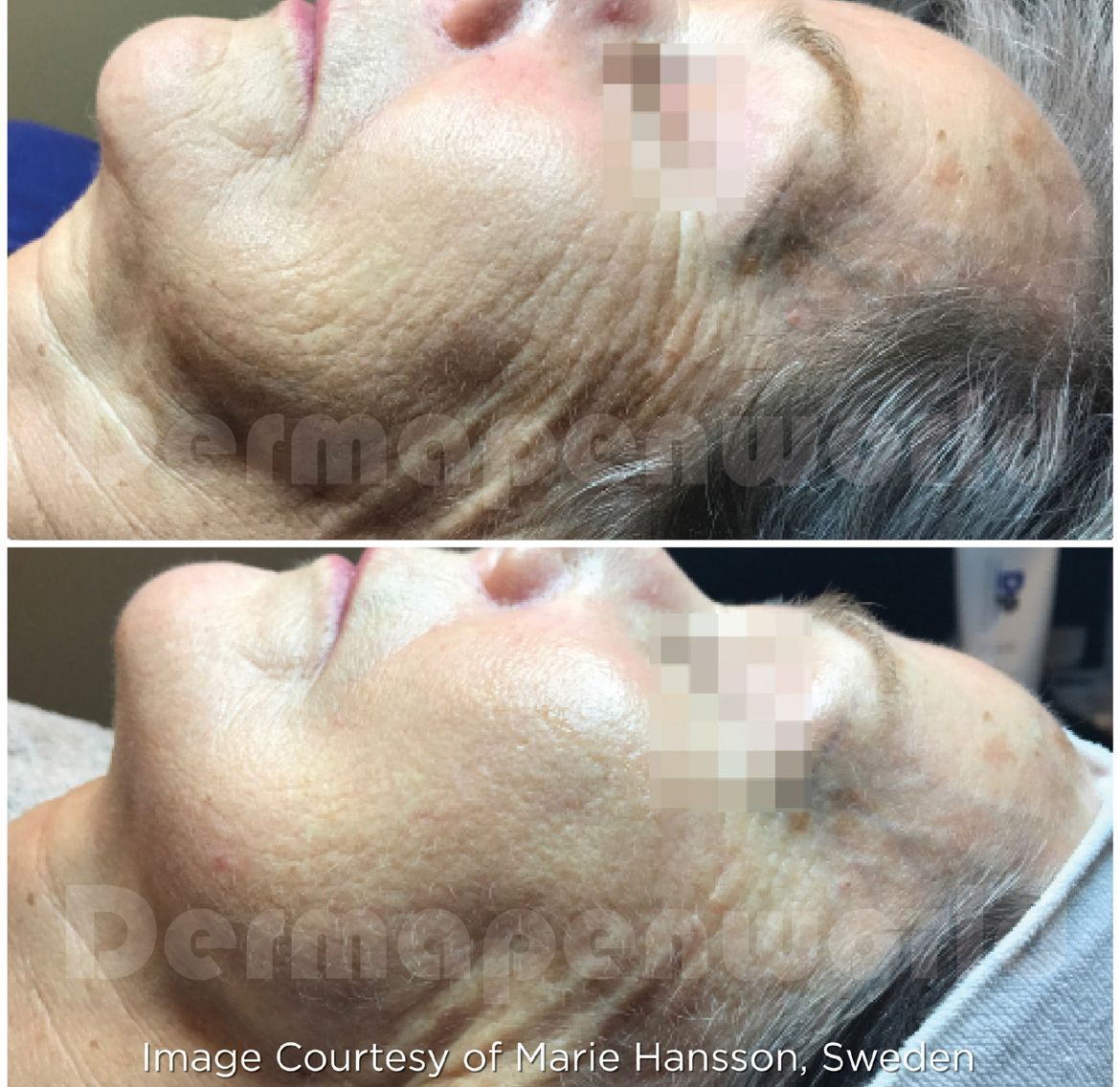 Ein Vorher-Nachher-Foto vom Gesicht einer Frau