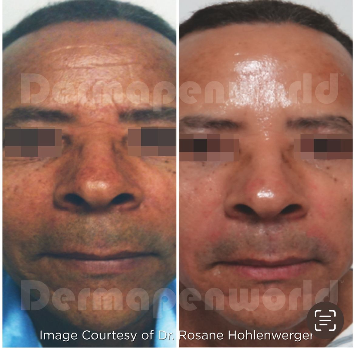 Ein Vorher-Nachher-Foto vom Gesicht eines Mannes