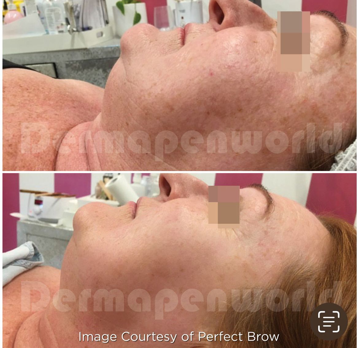 Ein Vorher-Nachher-Foto vom Gesicht einer Frau