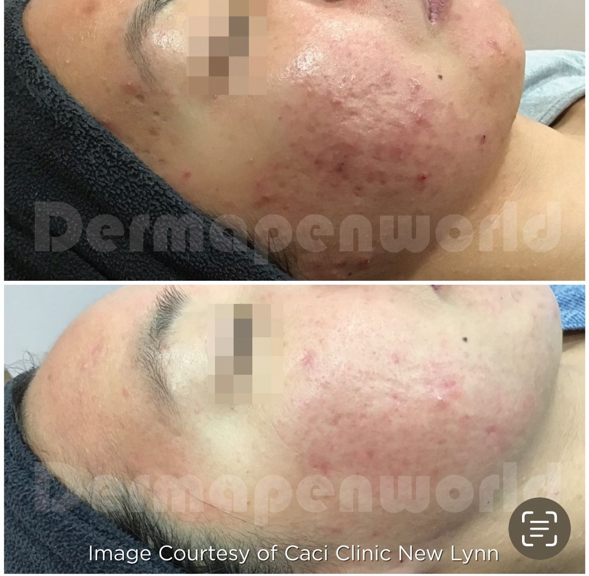 Ein Vorher-Nachher-Foto vom Gesicht einer Frau