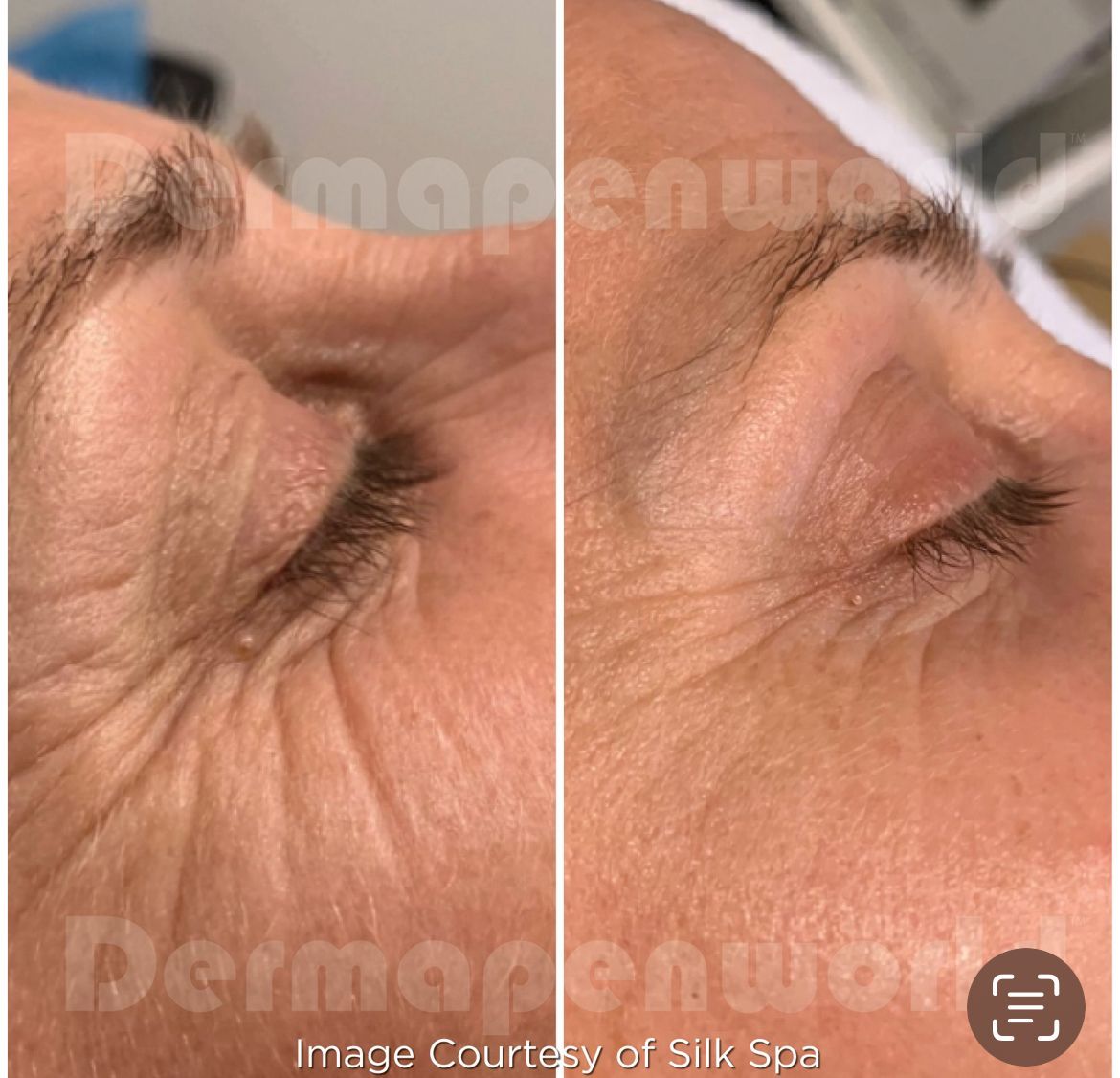 Ein Vorher-Nachher-Foto vom Gesicht einer Frau