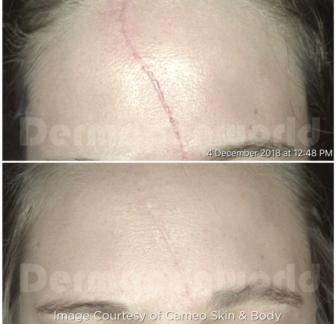 Ein Vorher-Nachher-Foto der Stirn einer Frau mit einer Narbe.