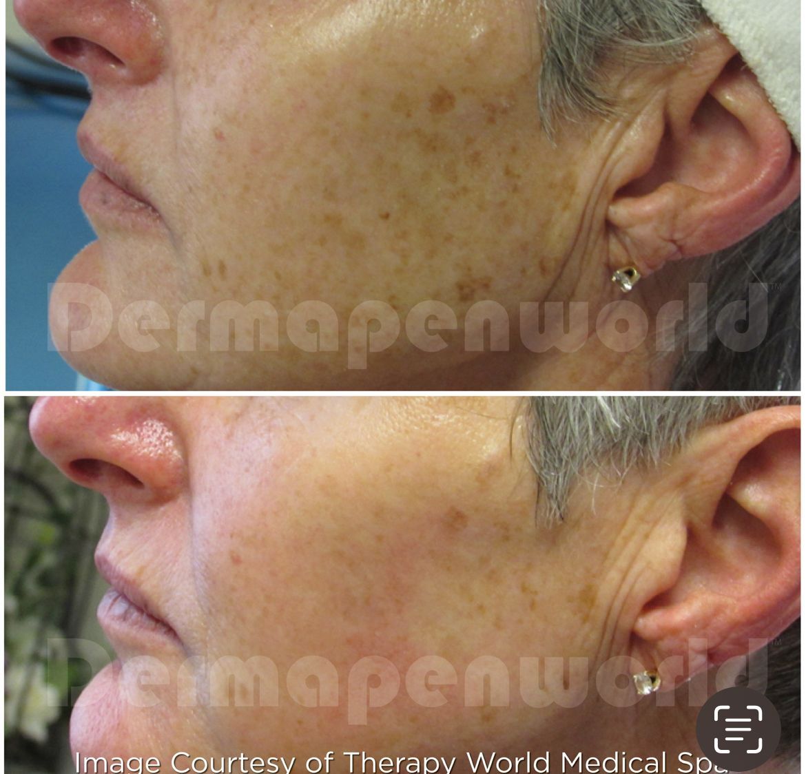 Ein Vorher-Nachher-Foto vom Gesicht einer Frau