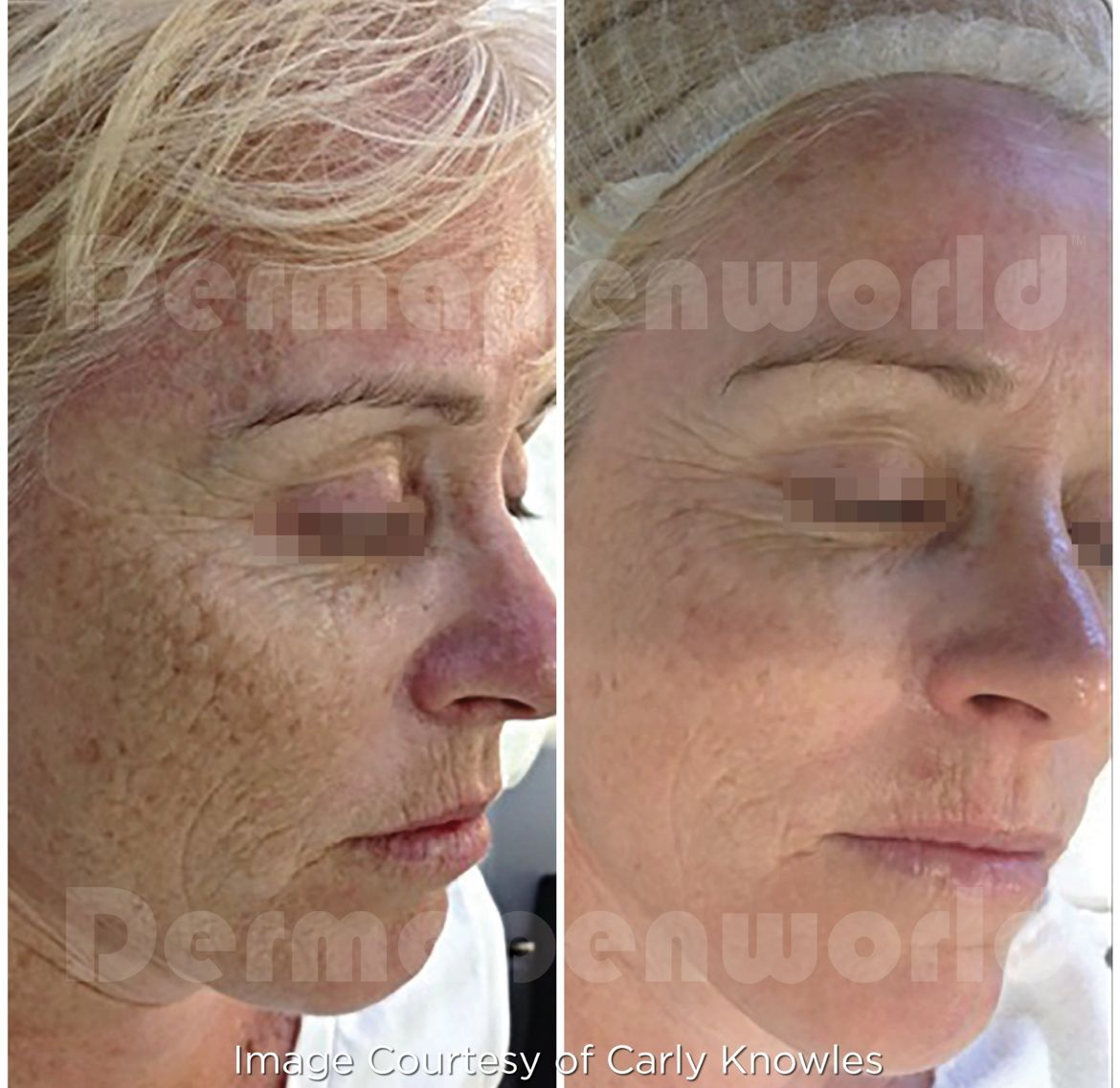 Ein Vorher-Nachher-Foto vom Gesicht einer Frau