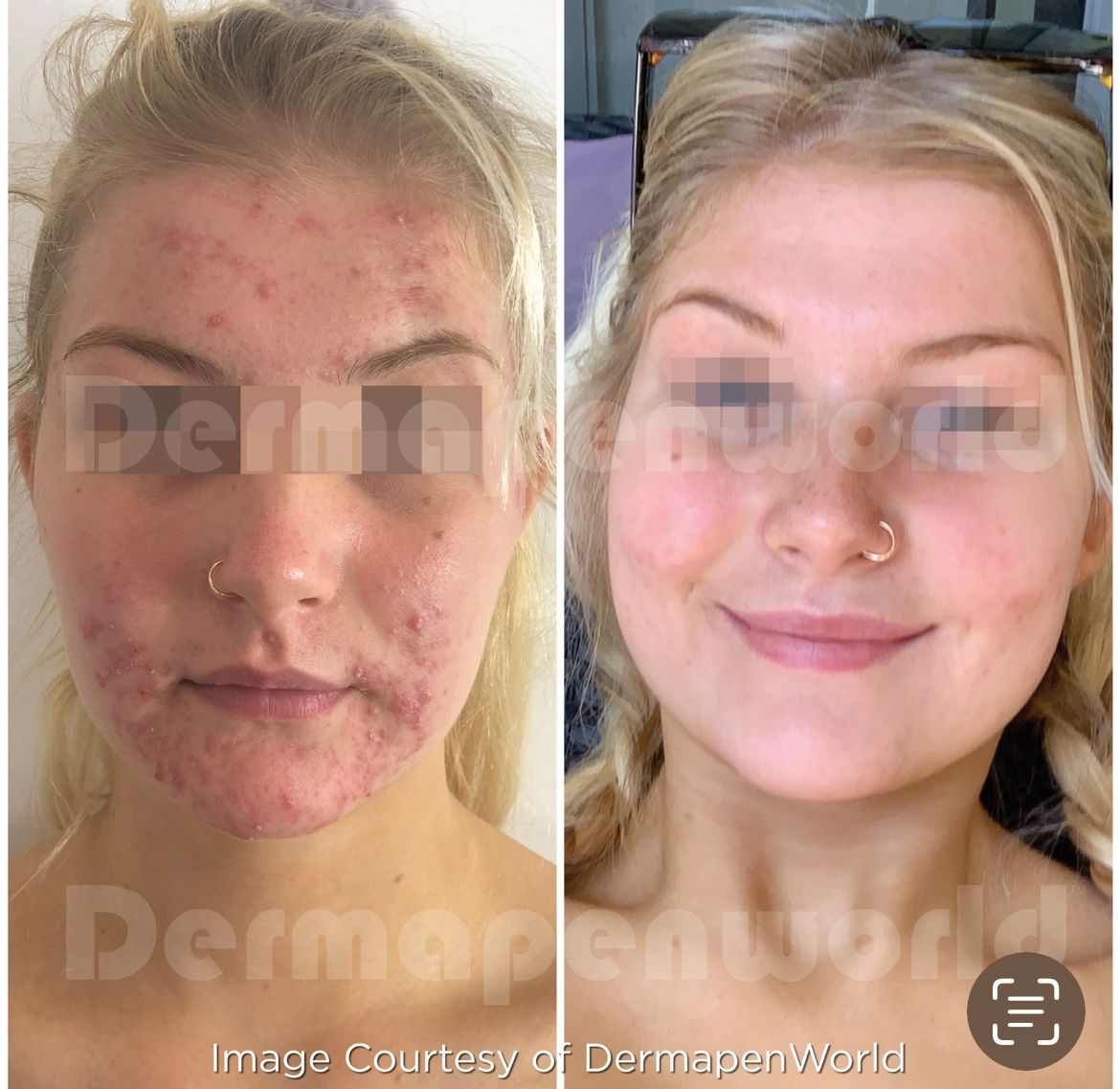 Ein Vorher-Nachher-Foto vom Gesicht einer Frau mit Akne