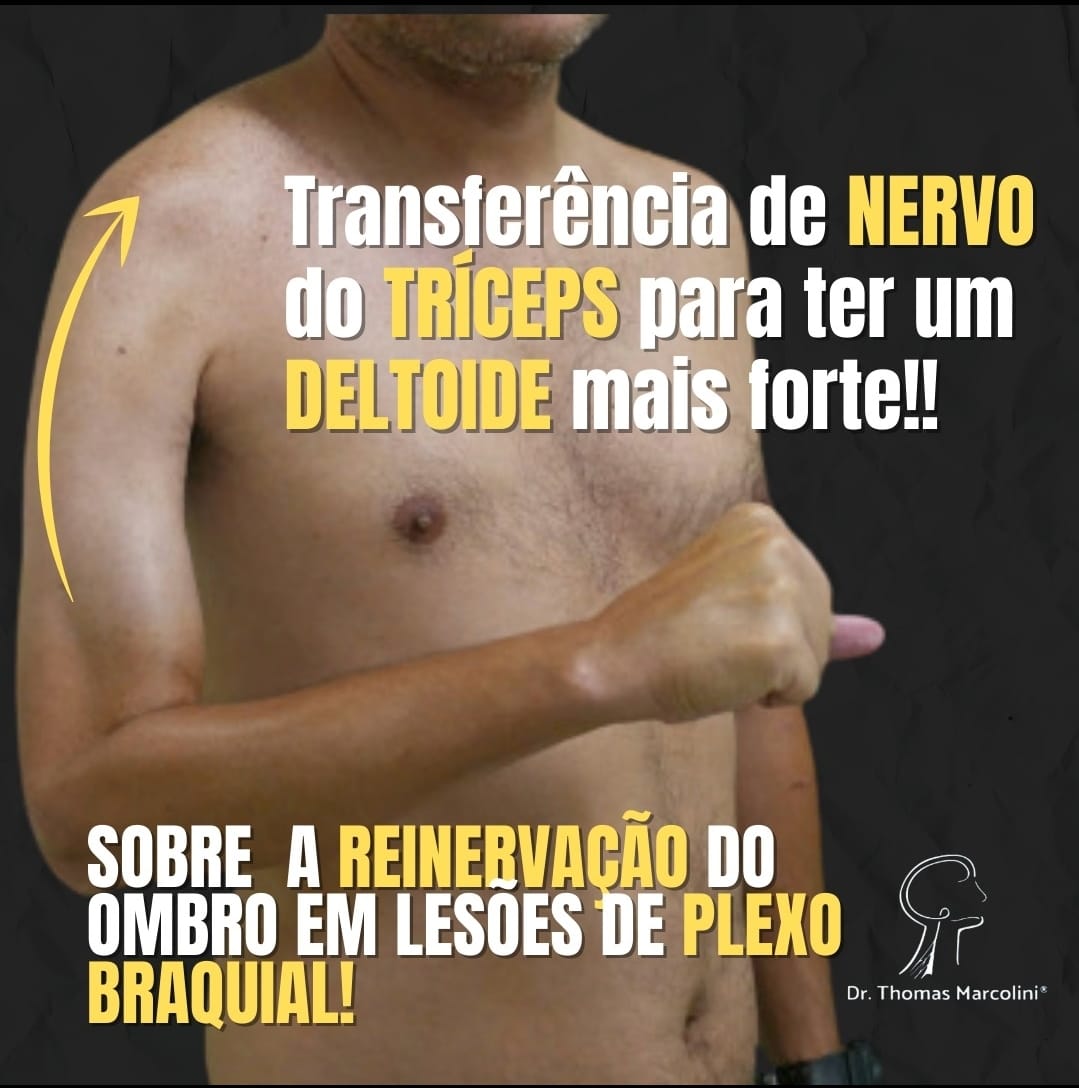 Cirurgia Para Fortalecer O Deltoide Após Uma Lesão De Plexo Braquial