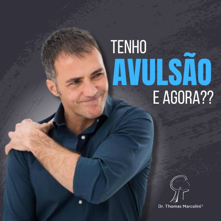 Tive Uma Avulsão Do Plexo Braquial, E Agora?