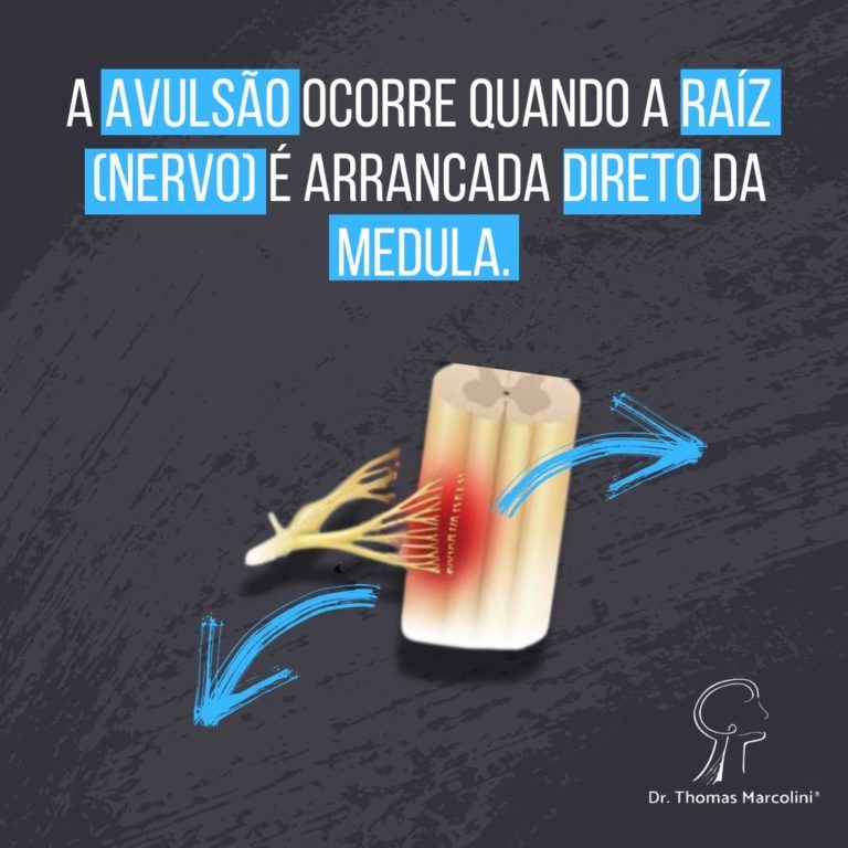 Quando ocorre uma avulsão?